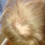 Alopecia Areata