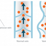varicose vein image