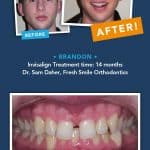invisalign results fix gapped teeth_brandon