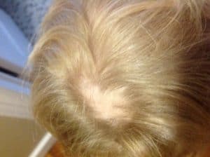 Alopecia Areata