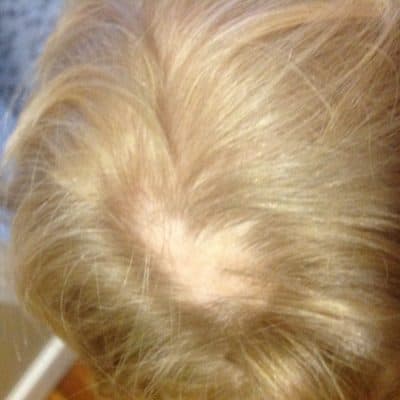 Alopecia Areata