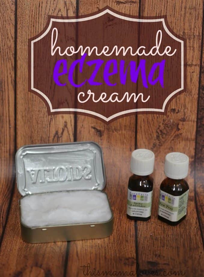 Homemade Eczema Cream Recipe This Mama Loves