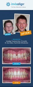 invisalign results fix gapped teeth_brandon