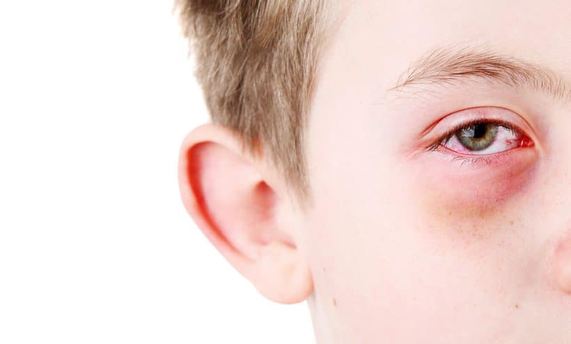 What to do when your kid has pink eye from This Mama Loves